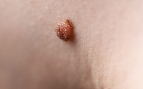 Co to jest włókniak? - Przewodnik po objawach, przyczynach powstawania i metodach przeciwdziałania